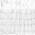 ekg